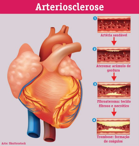 Aterosclerose: o que é, sintomas, tratamento e consequências 1 Aterosclerose
