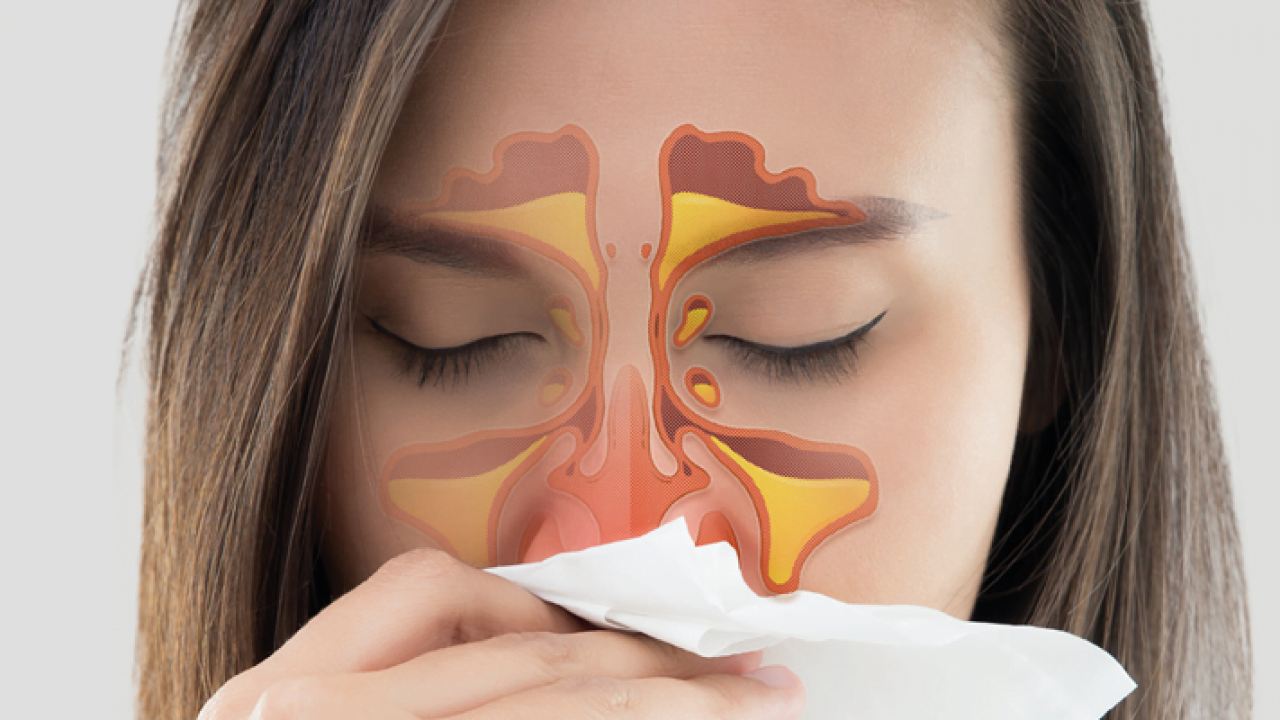 Rinite: Sintomas, remédios, tratamento