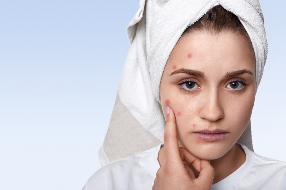 Acnever: Uma Possível Alternativa para o Cuidado com a Pele Acneica 3 espinhas acne