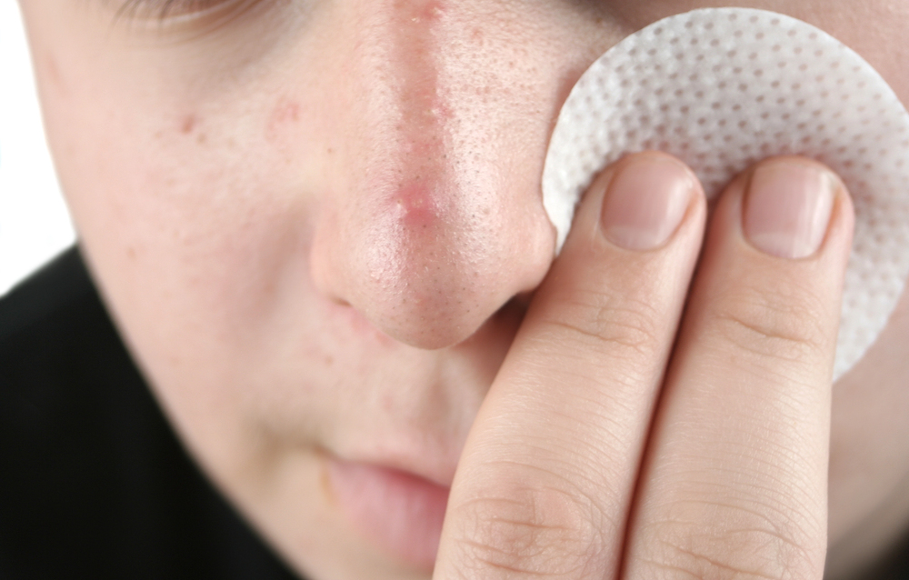 Acnever: Uma Possível Alternativa para o Cuidado com a Pele Acneica 2 limpar a pele com acne