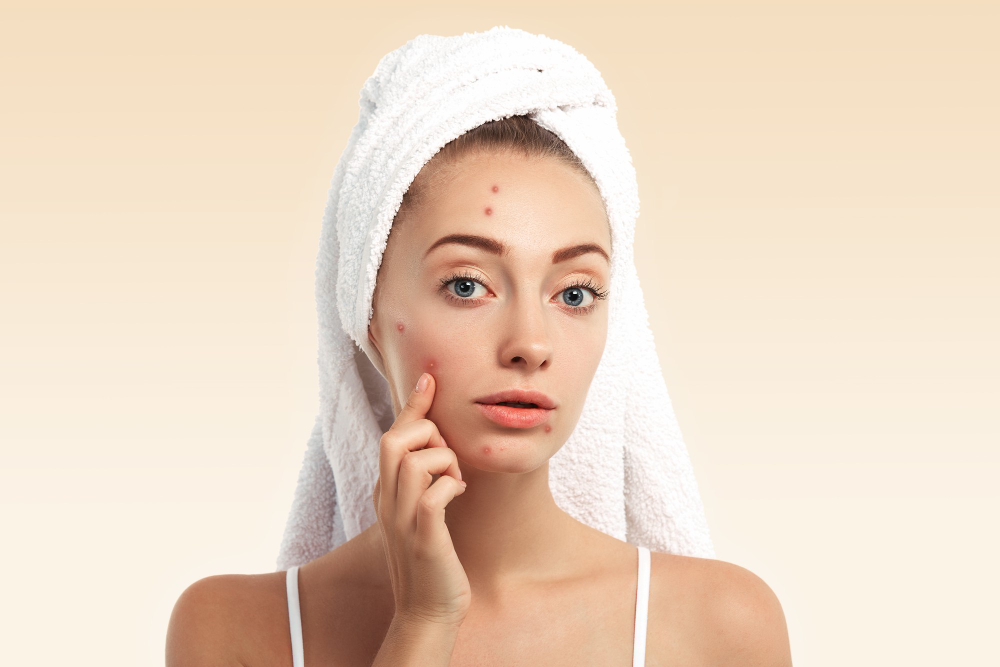 Acnever: Uma Possível Alternativa para o Cuidado com a Pele Acneica 4 pele com acne
